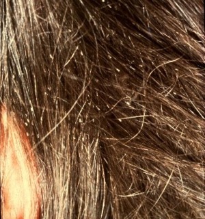 head lice nits in hair